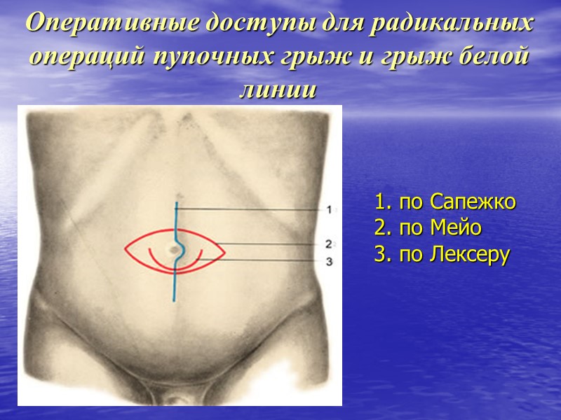 Оперативные доступы для радикальных операций пупочных грыж и грыж белой линии 1. по Сапежко